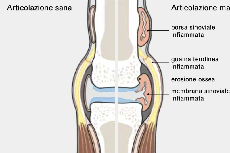 Articolazione sana, articolazine malate Rappresentazione schematica dell'articolazione: sana e affetta da artrite