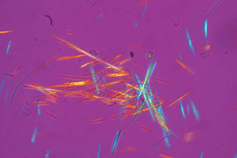 Cristalli di acido urico a forma di aghi presenti nel liquido sinoviale, osservati al microscopio a luce polarizzata. © Wikimedia Commons/Bobjgalindo La gotta al microscopio: cristalli di acido urico aghiformi fotografati in luce polarizzata da un campione di liquido sinoviale.