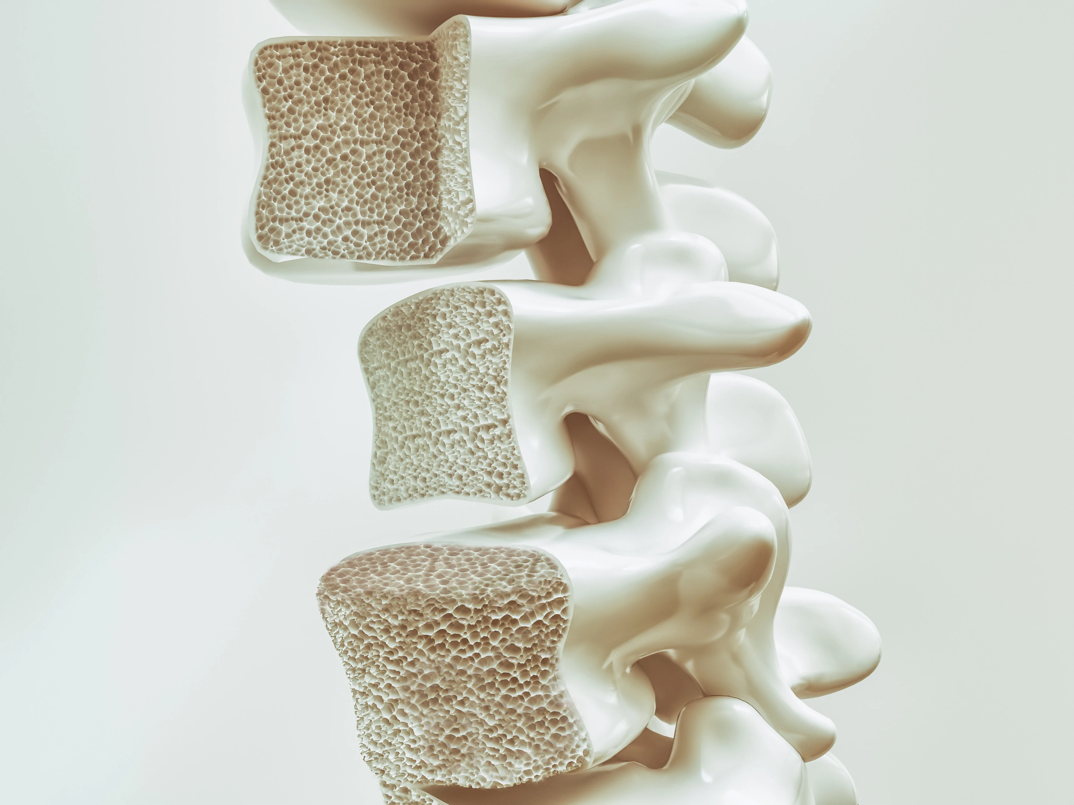 Osteoporose Wirbelsäule
