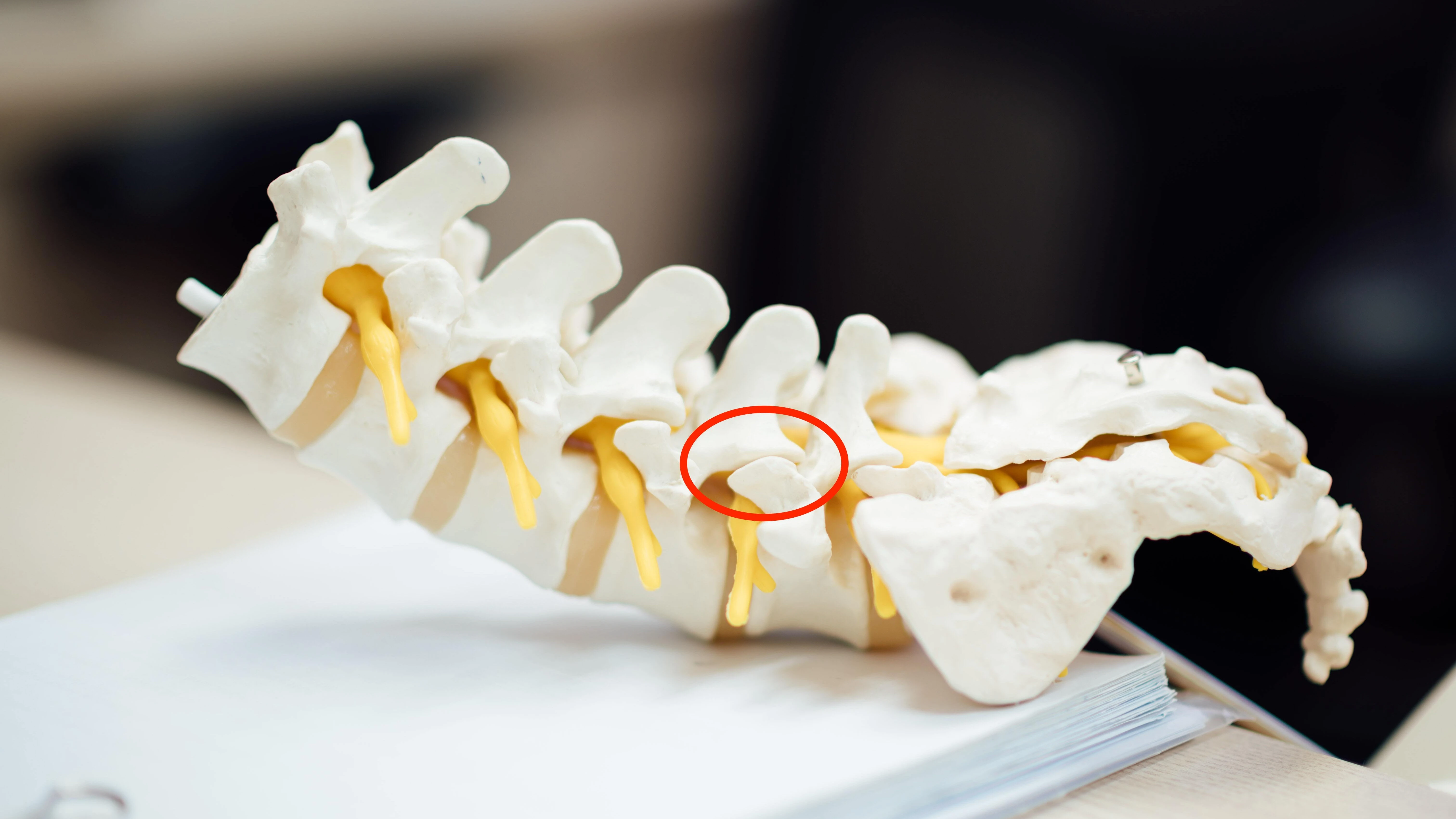 Spondylarthrose
