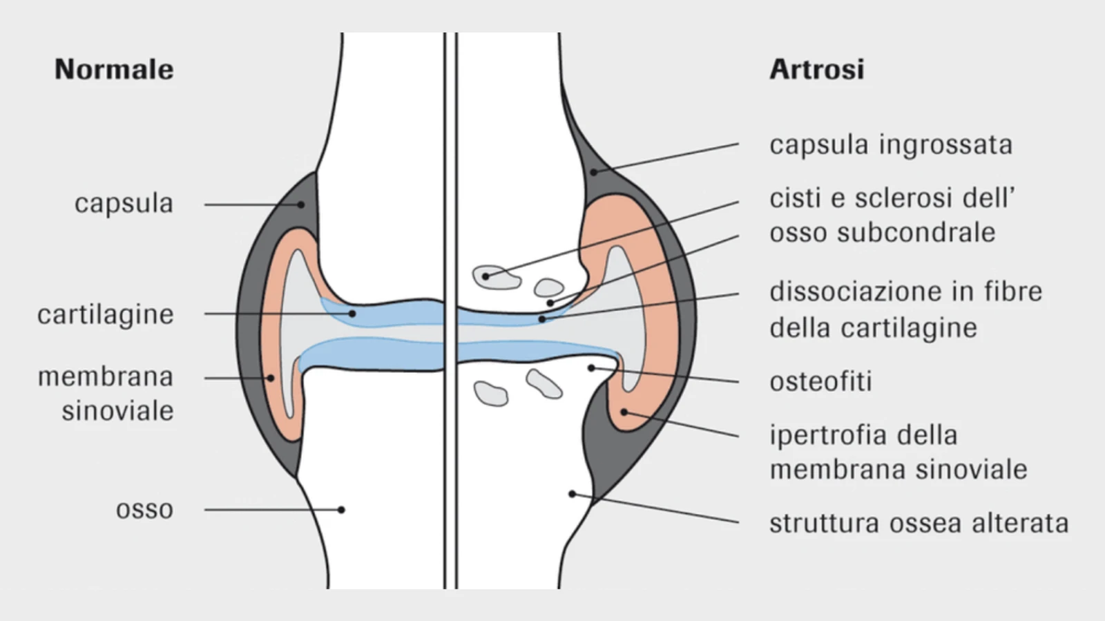 Artrosi Artrosi