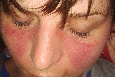 Il viso di una giovane donna con un'eruzione cutanea rossa